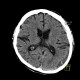 Rebleeding into chronic subdural hematoma: CT - Computed tomography